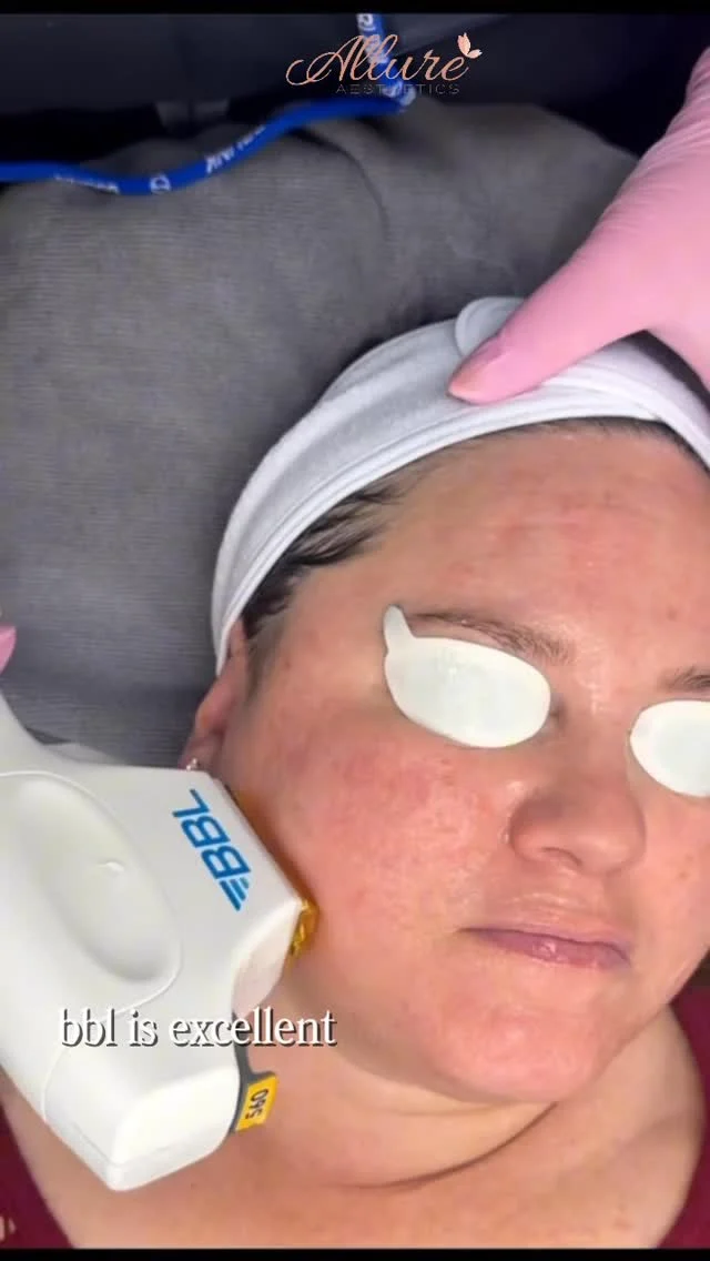 Moxi combined with BBL is one of our most effective ways to reset skin quality in a planned, age-supportive way.

We often reach for this pairing when a patient wants to address both pigment and texture in the same treatment course.

BBL (BroadBand Light) is used to target:
• Sun-induced pigmentation and uneven tone
• Diffuse redness and visible vessels

Moxi is layered in to focus on:
• Texture irregularities and early fine lines
• Overall dermal integrity and light reflection at the surface

Together, they support collagen, more even coloration, and smoother texture in real-life lighting with manageable downtime.

If you are interested in a Moxi and BBL plan tailored to your skin, you can schedule an appointment with our team through the link in bio!