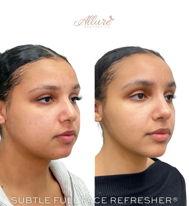 Subtle Full Face Refresher®

A refresh that enhances - never overpowers. ✨ For this beautiful client, we focused on balance, structure, and soft refinement from top to bottom.

💉 Upper Face Dysport
We treated the upper face and around the eyes to smooth expression lines while keeping natural movement.

💉 Masseter (Jaw Slimming) Dysport
By treating the masseters, we helped soften facial width and create a slimmer, more tapered lower face. This subtly enhances feminine contours while maintaining harmony.

💉 Non-Surgical Rhinoplasty 👃 
Using strategic filler placement, we camouflaged her dorsal hump and created the illusion of a softer slope. No surgery - just precise artistry to balance her profile and refine the nose from every angle.

💉 Chin Filler + Jawline Enhancement
Her lower face was gently structured with chin filler to support projection and balance. This created stronger definition along the jawline, improved side profile harmony, and gave her lower third a beautifully proportioned finish.

Full face treatments are about harmony - every feature working together. 

✨ Results may vary
