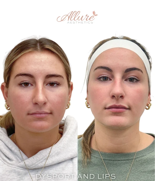 Full upper face Dysport + lip enhancement transformation ✨

For this client, we treated the upper face with Dysport to soften the appearance of resting lines and dynamic wrinkles - creating a smoother, refreshed look without looking frozen. Notice how her expression still looks natural, just more polished.

We were also able to create a beautifully lifted brow effect using strategic placement, opening up the eye area and enhancing her natural shape.

As a Dysport master technique, precise dosing allowed us to subtly slim the lower face, giving her a more sculpted, refined V-shape profile.

For her lips, we kept things soft and balanced. The goal wasn’t “bigger” - it was symmetry, definition, and structure. A subtle enhancement that enhances her natural beauty while improving overall harmony.

Balanced. Refined. Elevated. 💉✨