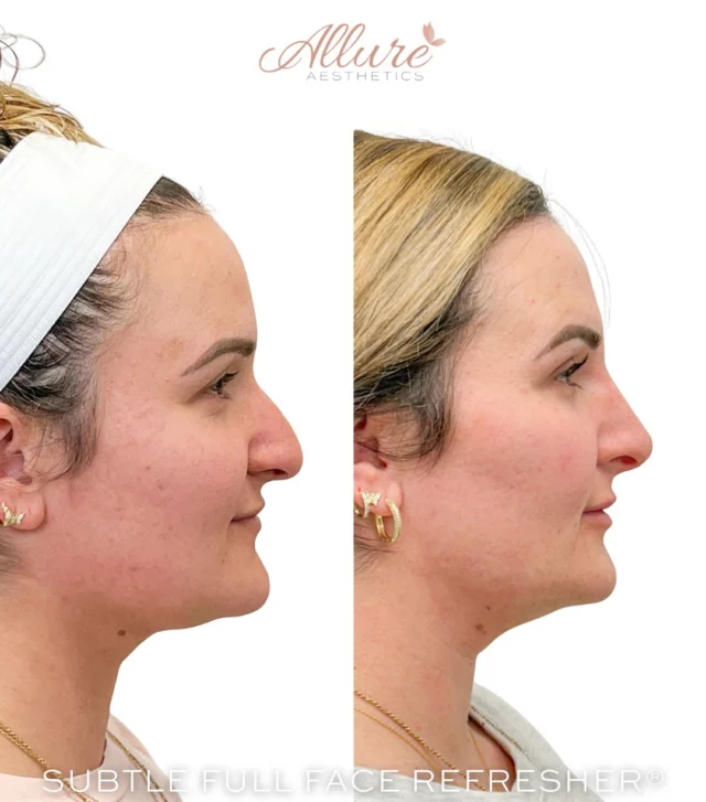 SUBTLE FULL FACE REFRESHER®

For this beauty, our goal was refinement — not change. Just a refreshed, elevated version of her natural features.

✨ Dysport was strategically placed to soften fine lines and smooth expression areas while maintaining natural movement.

✨ Non-Surgical Rhinoplasty became the true highlight of this transformation. By placing filler with precision, we were able to gently lift and support the nasal tip, correcting the slight downward turn and creating a more balanced, harmonious profile — all without surgery. The result is subtle, but the difference in facial balance is powerful.

✨ Cheek enhancement provided a delicate lift and light contour, restoring support through the midface and tying the entire look together.

This is what a Subtle Full Face Refresher® is all about — small, intentional adjustments that create overall harmony. Results may vary.