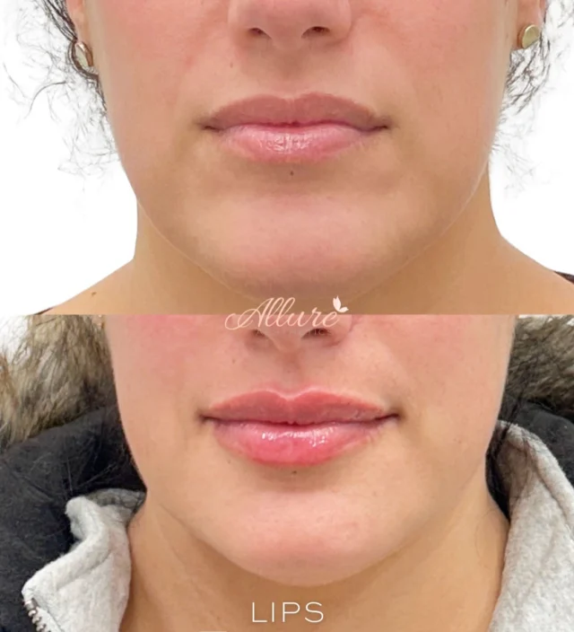 LIPS 👄 

For this beautiful client, our focus was definition and balance.

We enhanced her natural shape by refining the borders and creating a more pronounced Cupid’s bow for that soft, feminine contour. By strategically adding height and volume, we were able to give her lips a fuller, more structured appearance — without looking overdone.

The result? Elevated, defined, and beautifully proportioned lips that still feel completely natural to her features. 

✨Results may vary.