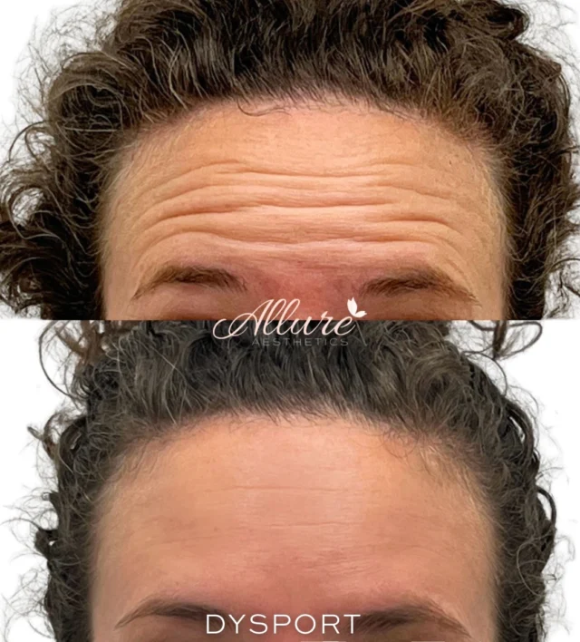 Your expressions tell your story… but they don’t have to tell your age. ✨

When we smile, those little lines around the eyes (hello crow’s feet) start to settle in.
When we raise our brows, the fine lines across the forehead become more noticeable.
And when we make that “mad” or concentrated face? The lines between the brows can deepen over time.

With Dysport, we’re not freezing your face — we’re softening those repetitive expression lines so you still look like YOU… just smoother, refreshed, and more rested.

• Softer crow’s feet when smiling
• Smoother forehead when raising brows
• A more relaxed look between the brows

Natural movement. Refined results. Elevated confidence.

Ready for a refreshed version of you? 💉✨ 

Results may vary.