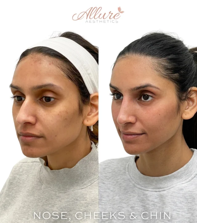 Non-surgical Rhinoplasty, Cheeks & Chin ✨🙌

For this beauty, we focused on balance, proportion, and soft refinement.

We performed a non-surgical rhinoplasty to create the illusion of a smaller, more refined nose by strategically camouflaging her dorsal hump and improving profile harmony. The result? A smoother contour and an overall wow factor without surgery.

Her cheeks were thoughtfully enhanced to restore lift and contour, giving her mid-face a more sculpted, youthful appearance while maintaining natural movement.

And for her chin, we strengthened and projected what was once a softer, weaker profile to create better facial balance and symmetry. That small adjustment made a powerful difference in her overall harmony.

This is what subtle refinement looks like.
Balanced. Elevated. Undetectable.

✨Individual results may vary.