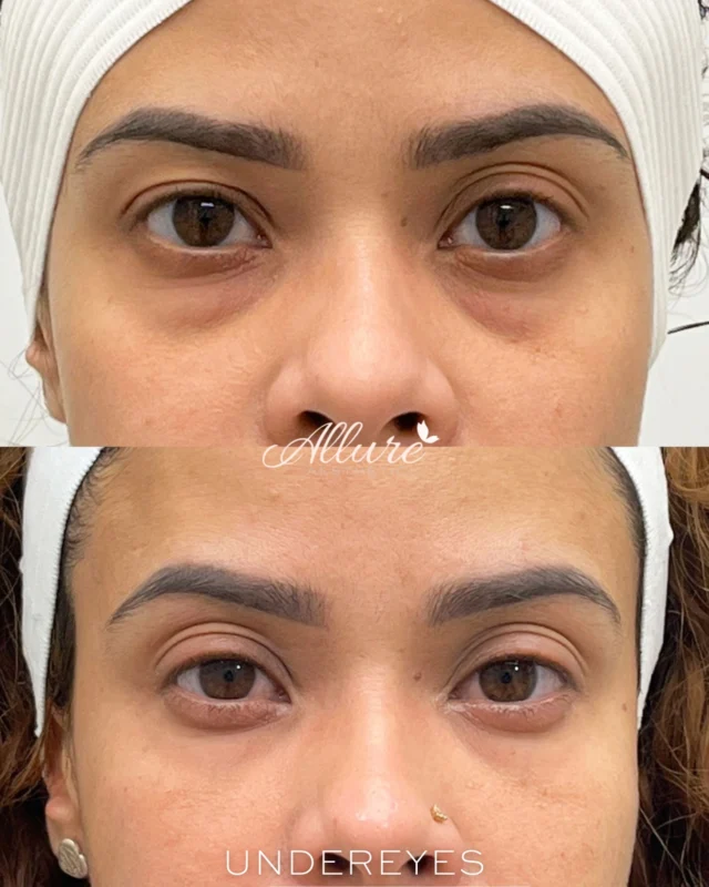 ✨ UNDER-EYES✨

With strategically placed under-eye filler, we were able to soften hollowing, reduce the appearance of dark circles, and restore subtle volume to the tear trough area — creating a smoother transition from the lower eyelid to the cheek.

The result?
A brighter, more rested, and naturally refreshed appearance without changing the beauty of her features.

Sometimes the smallest adjustments make the biggest difference.
More awake. More refreshed. Still completely you.

If you’ve ever felt like your under-eyes make you look more tired than you feel, this treatment may be the perfect solution.

Results may vary from each individual.