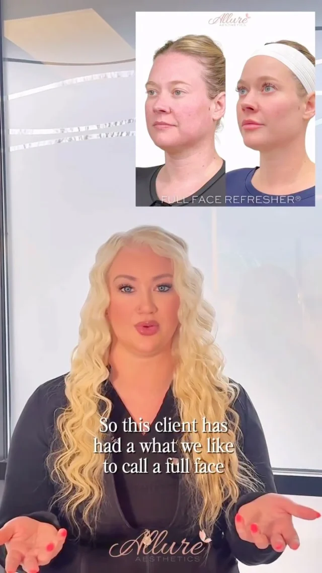 Creating a Full Face Refresher® is never about treating just one area - it’s about restoring balance to the entire face.

For this beautiful client, we approached her treatment step-by-step. First, we evaluated her facial structure and areas that had lost volume over time. From there, we strategically added support to key areas like the cheeks and midface to create lift, improved projection through the chin for balance, and softened areas that were contributing to heaviness or shadowing.

A Full Face Refresher® is a process -it’s thoughtful, customized, and designed specifically for your facial anatomy and goals.

The goal is always the same: natural, refreshed, and beautifully balanced results.

✨ Results may vary for each individual.
