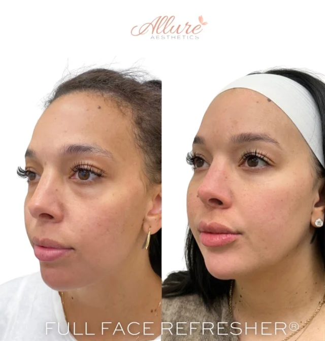 FULL FACE REFRESHER®

For this beautiful client - she’s been with us since 2020 and has consistently maintained her treatments over the years. Staying on top of your aesthetic plan makes all the difference when it comes to achieving refined, natural results.

For her Full Face Refresher®, we performed:
• Full-face Dysport
• Lip enhancement
• Cheek contouring
• Jawline definition
• Under-eye rejuvenation

The goal is never to change - it’s to maintain, refine, and elevate. When treatments are done thoughtfully and consistently, the result is balanced, harmonious, and beautifully subtle.

Every face is different. Product amounts, placement, and overall outcome will vary based on anatomy, structure, and individual goals. ✨ Results may vary