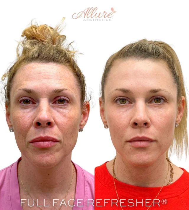 Full Face Refresher® ✨

For this beautiful client, we created a customized full-face treatment plan designed to enhance balance, soften lines, and restore youthful structure.

Treatment included:
• Dysport
• Temple restoration
• Smile line treatment
• Cheek enhancement
• Medical-grade ZO Skin Health to support overall skin quality

Subtle, strategic enhancements that refresh the face while maintaining natural beauty.

Results may vary.