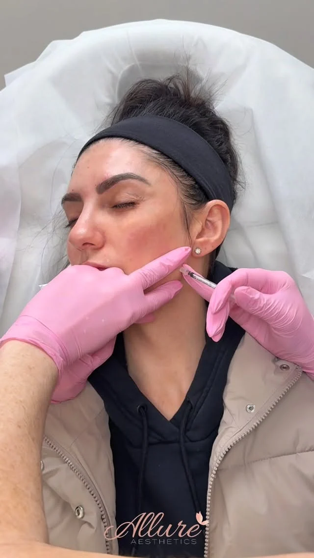 A full-face approach to refinement, balance, and soft rejuvenation ✨

This treatment focused on strategically placed Dysport to enhance overall facial harmony, targeting the upper face, crow’s feet, and the area between the brows to smooth expression lines while maintaining natural movement.

We also addressed the chin to soften dimpling and improve texture, along with the masseter muscles to create a more contoured, sculpted lower face.

Every injection is intentional. Every result is customized.

At Allure Aesthetics, we don’t chase trends, we deliver refined, elevated outcomes designed specifically for you.

Results will continue to settle over the next 10–14 days. Results may vary per individual.

#AllureAesthetics #DysportTreatment #FullFaceBalancing #FacialRefinement #medicalspa