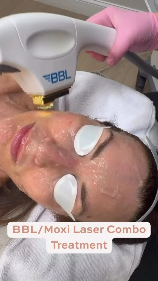 Broadband Light (BBL) + MOXI — the ultimate skin refresh.

When advanced light technology meets gentle resurfacing, you get a treatment designed to target tone, texture, and overall skin quality - without disrupting your routine.

Our BBL + MOXI combination works beneath the surface to improve the appearance of sun damage, uneven pigmentation, and early signs of aging, while refining texture and boosting that natural, healthy glow.

This is the go-to for clients looking to maintain radiant, youthful skin with a treatment that’s both effective and efficient.

Subtle. Refined. Results-driven.

Ready to elevate your skin? Message us to learn more or schedule your appointment.

Results may vary per individual.

#BBLMoxi #AllureAesthetics #SkinRejuvenation #MedicalAesthetics #HealthySkin