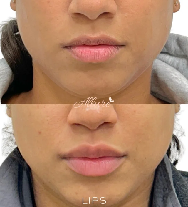 ✨ Let’s Talk Lips: Hydration + Soft Volume ✨

Beautiful lips are not just about adding volume - they’re about balance, hydration, and smooth texture.

In this transformation, we focused on restoring deep hydration to the lips, which helps soften the appearance of fine lip lines while enhancing the natural shape of the lip border.

Notice how the lips appear:
• smoother
• more hydrated
• naturally fuller
• beautifully defined without looking overdone

When lips are properly hydrated and supported, the entire lip surface looks healthier, softer, and more youthful.

Subtle refinements like this can make a powerful difference while still keeping everything natural and harmonious with the face.

Results may vary from each individual.