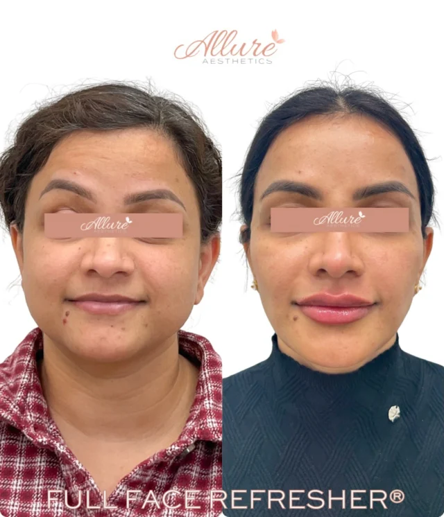 Full Face Refresher®

A refined approach to facial balancing - where structure, proportion, and precision come together to enhance without overfilling. Each area is strategically treated to restore harmony across the full face while maintaining natural movement and definition.

Her treatment included:

• Temples
• Non-surgical rhinoplasty
• Under eyes
• Cheeks
• Smile lines
• Lips
• Chin
• Jawline
• Full face Dysport

The goal is never to change - only to elevate, refine, and bring everything into balance.

Results may vary per individual.

#AllureAesthetics #FullFaceRefresher #FacialBalancing #RefinedResults #beforeandafter