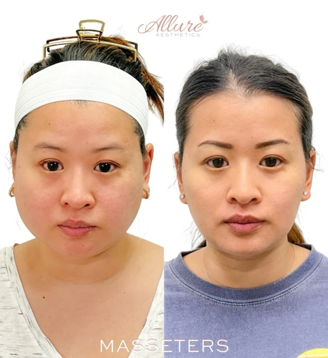 Masseter refinement for a beautifully sculpted, balanced profile.

For this client, treatment of the masseter muscle helped soften the lower face, creating a more contoured, tapered appearance. By relaxing the bulk of the muscle, we were able to achieve a noticeably slimmer facial silhouette while enhancing overall harmony.

The result is a refined, V-shaped look that still feels natural - never overdone, just elevated.

Subtle adjustments. Significant impact.

Results may vary per individual.

#MasseterBotox #FacialContouring #VLineJaw #AllureAesthetics #RefinedBeauty
