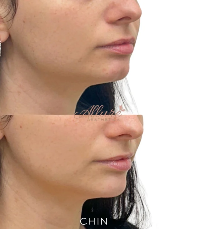 ✨💉 CHIN 💉✨

This beautiful client came in wanting to smooth out the natural indentation in her chin, often referred to as a “dimple chin.” By strategically placing filler, we were able to soften the indentation, create a smoother contour, and enhance the overall balance of her lower face.

The result is a more refined, structured chin that still looks completely natural — just the way she envisioned it. Small enhancements like chin filler can make a big difference in overall facial harmony and profile balance.

Results may vary per individual.

#ChinFiller #FacialBalancing #DermalFiller #MedSpaResults #AestheticTreatment