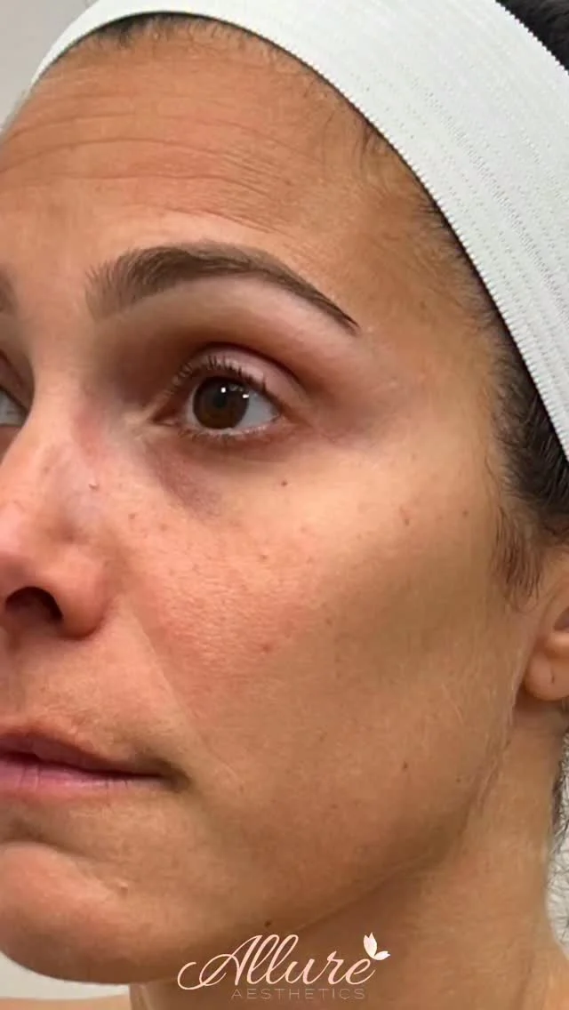 Refined skin, elevated results ✨

For this beautiful client, we performed SkinPen® microneedling to stimulate collagen, improve texture, and enhance overall skin quality - revealing a smoother, more radiant complexion.

To maintain and elevate her results, she’s on a customized ZO® Skin Health regimen, including the New Peptide Facial Refining Concentrate to support firmness, hydration, and ongoing skin renewal.

Clinical, corrective, and always tailored—because your skin deserves a strategy, not a guess.

Results may vary per individual.

#AllureAesthetics #SkinPen #Microneedling #ZOSkinHealth #SkinRejuvenation