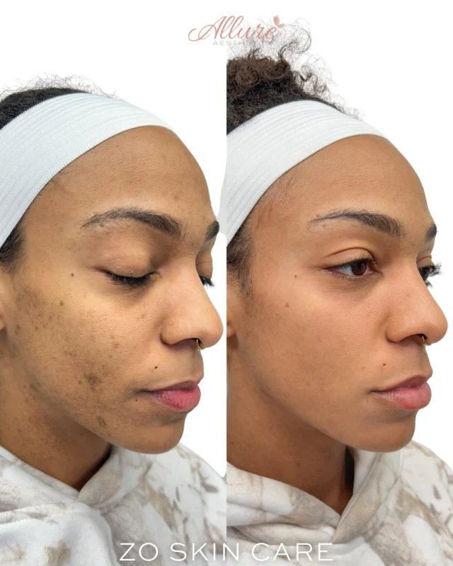 Just 5 weeks into a customized ZO Skin Health skincare regimen and the improvement is already significant.
This patient began a tailored protocol focused on improving hyperpigmentation, uneven texture, post-acne scarring, and overall skin health through consistent, corrective home care.🙌

At just five weeks, we are already seeing brighter, more even-looking skin, smoother texture, and healthier overall skin quality.💕

One of the most underrated truths in skincare: your home care should be actively transforming your skin. Real results come from expert guidance, consistency, and a regimen designed specifically for your skin’s needs, not just random trending products.😊

If your current skincare routine is not producing visible change, it may be time for a more customized approach.
Comment “ZO” below and we’ll DM you information on how to get started with a personalized skincare regimen designed for your skin goals. 

Results may vary per individual. ✨