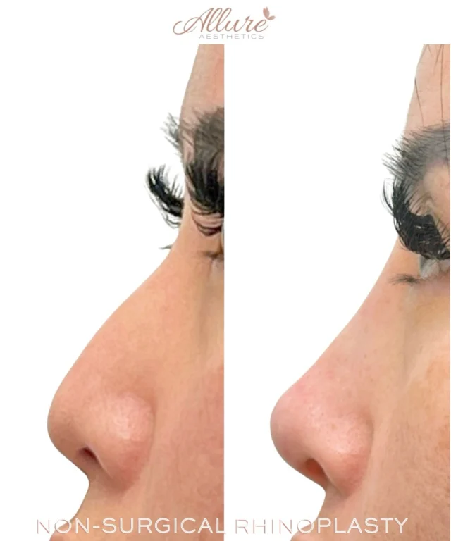Non-Surgical Rhinoplasty 👃 

For this beautiful patient, our provider performed a non-surgical rhinoplasty using a precise, refined treatment approach to enhance her natural profile.

By strategically placing filler, we were able to smooth the dorsal hump, create a more seamless contour, and subtly lift the tip—resulting in a more balanced and harmonious appearance.

This subtle enhancement preserves her natural features while elevating overall facial harmony. 

✨ Results may vary ✨