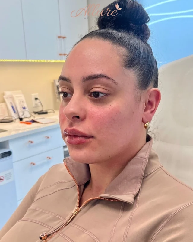 "Lips, cheeks, & smile lines—refined in all the right places ✨

For this beautiful client, we enhanced the lips with a soft, hydrated plump - creating that smooth, balanced volume Allure is known for. Her smile lines were gently softened to restore a more refreshed, rested appearance without compromising natural movement.

The cheeks made the biggest difference - strategically adding volume to lift and contour the mid-face, giving her that subtle, youthful definition and overall elevated look.

A customized, multi-area enhancement designed for balance, never overdone, just effortlessly refined.

Results may vary per individual.

#AllureAesthetics #FacialBalancing #LipFiller #CheekFiller #SmileLineFiller"