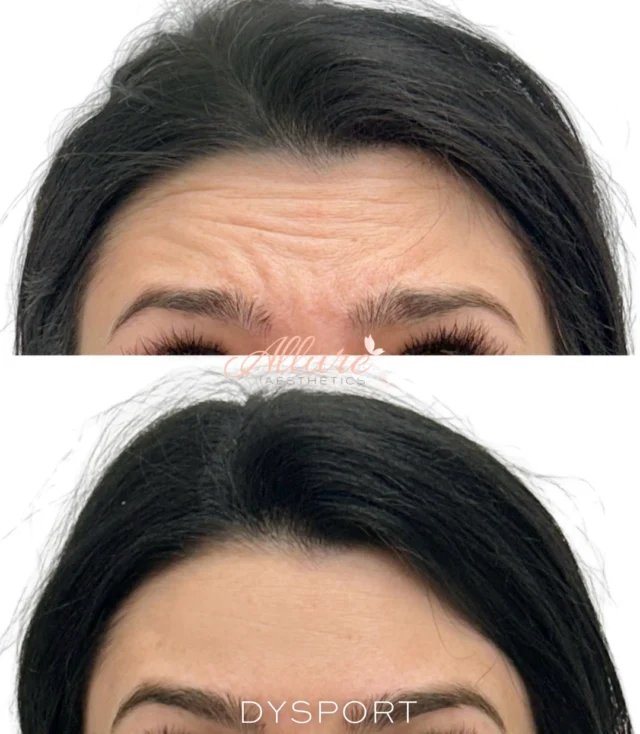 Dysport for the upper face - where expression meets precision.

Every time you raise your brows, frown, or smile, those repeated muscle movements begin to create lines across the forehead, between the brows, and around the eyes.

Dysport works to soften these expression lines while maintaining natural movement - so you still look like you, just more refreshed.

Subtle, refined, and tailored to you.

✨Results may vary

#AllureAesthetics #Dysport #MedicalAesthetics #FacialRejuvenation #NaturalResults