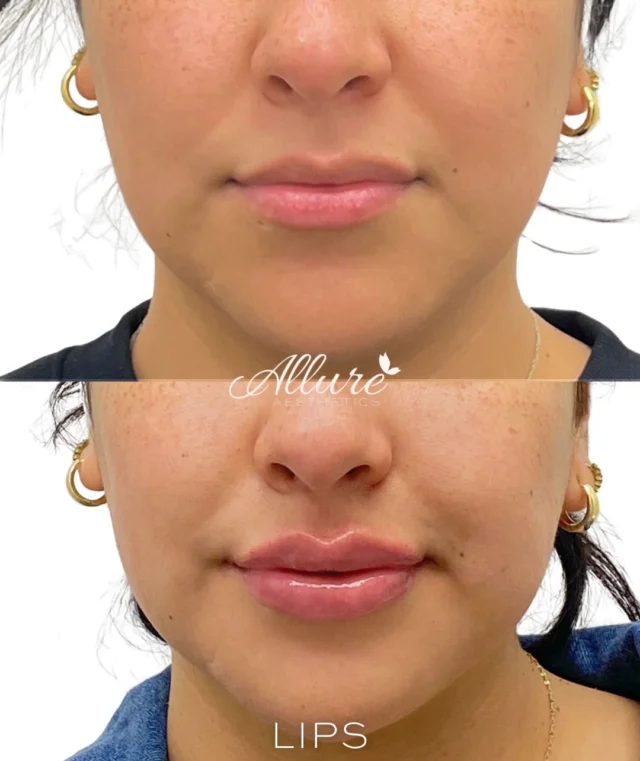 Lips💋

For this beautiful client, we achieved this look over two sessions using a total of 1.5 syringes - focusing on precision, balance, and soft enhancement.

We enhanced and defined the Cupid’s bow to create more structure, while adding height and volume for a fuller, yet natural-looking result. The goal was never overdone—just elevated, hydrated, and beautifully refined.

Results shown are immediately post-treatment; swelling is present. ✨

Results may vary per individual.

#AllureAesthetics #LipFiller #CupidBow #LipEnhancement #NaturalBeauty