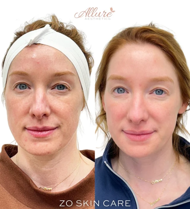 ZO® Skin Health Transformation✨

At Allure Aesthetics, we focus on restoring skin function, not quick fixes, but creating skin that is healthy and performing at its best.

This progress reflects the consistency of a customized home care regimen designed to support and optimize skin over time, with adjustments made as the skin evolves.

We’re currently developing a guided ZO Skin Health program for those who want real results from home, with expert support every step of the way.

Patients will be enrolled through our portal and receive a fully customized regimen, ongoing guidance, and professional oversight.

If you’d like to join the waitlist or learn more as details are released, comment ZO and our team will reach out.

Results may vary.