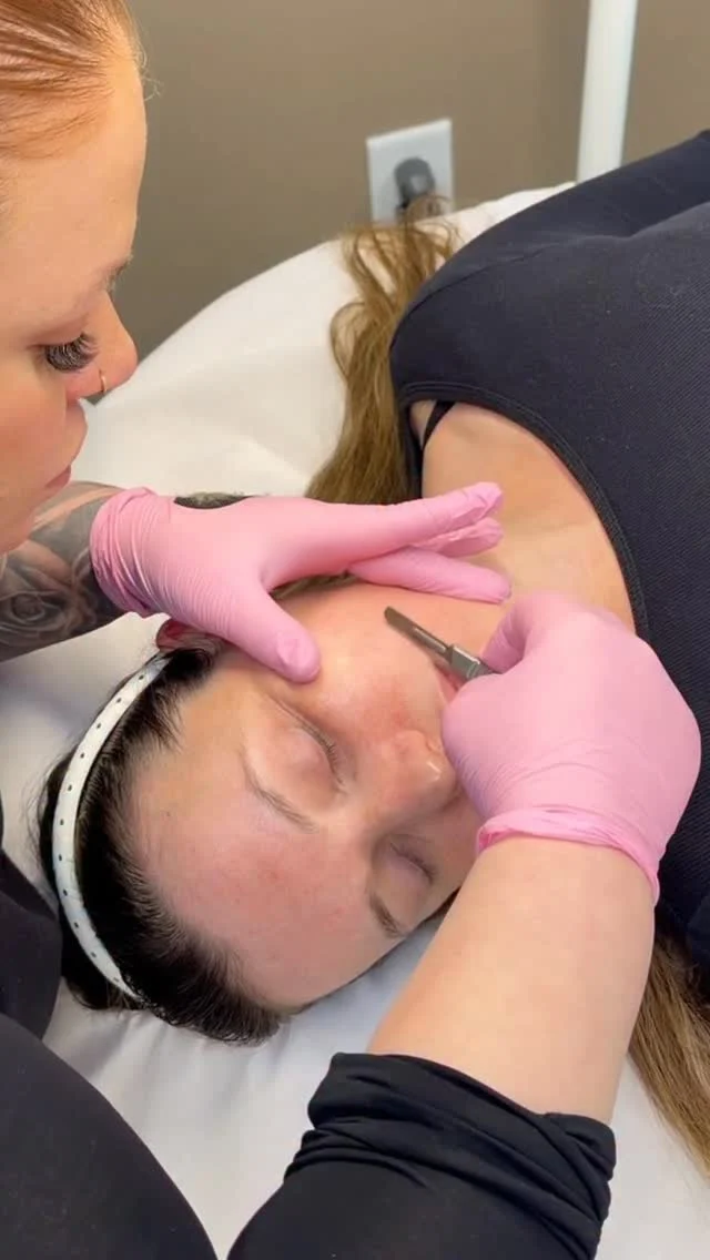 SkinPen Microneedling. ✨

At Allure Aesthetics, every skin treatment is approached with purpose. focusing on what will deliver the most effective, long-term results for your skin.

For this client, SkinPen® microneedling was paired with dermaplaning and a ZO Skin Health Stimulator Peel beforehand — delivering an instant glow and smoother texture upfront, while supporting more refined results over time.

We offer multiple ways to enhance SkinPen depending on your skin’s needs, including targeted ZO Accelerated Serums, PRF, and light-depth peel options.

Everything we incorporate is intentional. We focus on combinations we’ve seen deliver consistent results and remain selective, prioritizing real outcomes over trends. We also carefully consider your skin type and individual factors to ensure each approach is both safe and effective.

Our goal isn’t just a single treatment — it’s building a plan that creates real, lasting improvement.

Your provider will guide these decisions during your visit because the best results come from a thoughtful, individualized approach