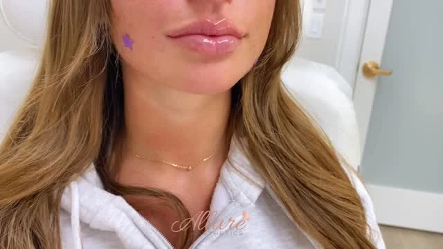 Precision matters most when treating lips.👄 

Freshly injected lips designed to improve border definition, restore proportion, and create balanced volume that complements the patient’s natural facial structure. Every treatment plan is customized with intention, never overfilled, never one-size-fits-all.✨

Immediate post-treatment swelling is expected, with final settling to follow over the next several days. Results may vary per individual.💕

Schedule your consultation to discuss a tailored lip enhancement plan. 

#LipFiller #LipEnhancement #FacialBalance #Lips #MedSpaExpert