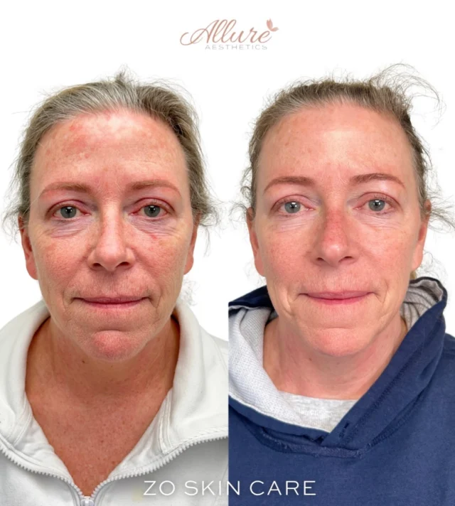 Just six weeks into a customized ZO Skin Health regimen, and already seeing impressive, visible improvements in skin quality, tone, and overall facial balance, achieved through advanced skincare alone. ✨

A more sculpted jawline, enhanced cheek volume appearance, smoother texture, and brighter, more even tone can be seen here, driven by the incorporation of the ZO Facial Refining Peptide. This advanced formulation helps soften the look of lines while supporting the skin’s natural production of hyaluronic acid, leaving the skin looking visibly plumper, firmer, and more refreshed over time. It also works to subtly lift and refine facial contours, even in areas where injectables aren’t always an option, making it a powerful standalone or the perfect complement to tox and filler treatments.

This is one of the newer ZO formulations we’ve been incorporating more frequently, and it’s quickly become a standout in our practice, with consistently strong feedback from both our patients and team.

Consistency, intentional product selection, and a tailored approach are what make results like this possible.

Results may vary per individual.