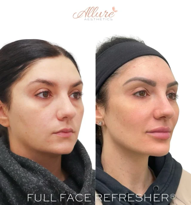 Full Face Refresher®

Consistency is where true transformation happens—and this beautiful client is the perfect example. She’s been with us since 2020, staying committed to maintaining and enhancing her results over time with a customized, full face approach.

Her treatments are strategically designed to support balance, structure, and long-term rejuvenation—never overdone, always refined.

✨ Treatment highlights:
• Full face Dysport (forehead → neck)
• Temples
• Cheeks
• Non-surgical rhinoplasty
• Lips
• Jawline contouring
• Chin + chin shadow correction
• Neck bands
• HydraFacial

A Full Face Refresher® isn’t about one area—it’s about treating the face as a whole for the most natural, harmonious result.

Results may vary per individual.
