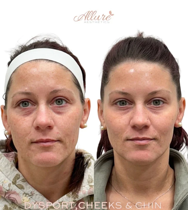 Dysport®, Cheeks & Chin ✨

For this beauty, we focused on enhancing and refining with a strategic, multi-area treatment plan, designed to keep everything soft, balanced, and natural.

Her treatment included:
• Upper face Dysport® to smooth and refresh the eye area
• A lip flip for subtle enhancement and improved shape
• DAO treatment to soften downward pull at the corners of the mouth
• Chin refinement for a subtle, natural contour
• Platysmal band treatment to smooth and tighten the neck
• Cheek enhancement to restore structure and support

Every detail was thoughtfully customized to her features-especially the chin, where a subtle adjustment can elevate overall harmony.

At Allure, it’s all about precision and tailored results, enhancing your natural beauty, never overdone.

Results may vary per individual.

#AllureAesthetics #Dysport #FacialBalancing #NaturalEnhancement #AestheticExpert