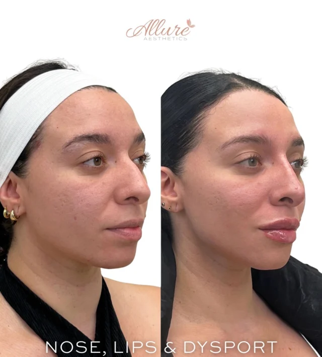 Non-Surgical Rhinoplasty, Lips & Dysport ✨

Refinement without surgery, strategically treating multiple areas to enhance overall facial balance.

For her nose 👃, we focused on camouflaging the dorsal hump by placing filler with precision along the bridge. This creates the appearance of a smoother, straighter profile while maintaining natural proportions.

For her lips 👄 , we enhanced overall definition with careful attention to the Cupid’s bow, adding subtle volume and structure for a balanced, hydrated result never overdone, always tailored.

To complete the look, Dysport 💉 was used to soften fine lines and create a smooth, refreshed appearance while preserving natural movement.

At Allure Aesthetics, every treatment is customized with intention because true results come from balance, not excess.💕

Results may vary per individual.

#AllureAesthetics #FacialBalancing #NonSurgicalRhinoplasty #LipFillerResults #Dysport