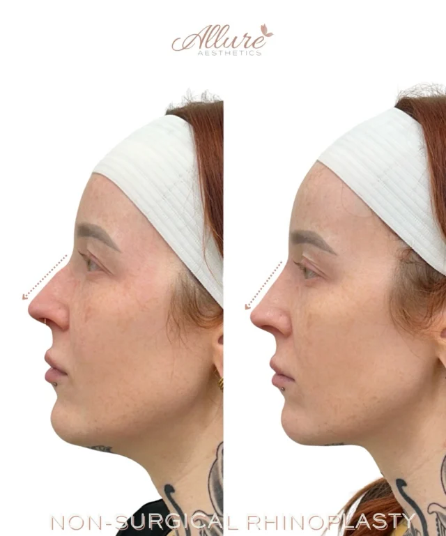 Profile balance without surgery. Precision over excess.✨

Non-surgical rhinoplasty 👃 was performed to improve nasal contour, soften the appearance of a dorsal hump, and create a smoother transition from bridge to tip without surgery or downtime. Strategic filler placement can enhance profile harmony by refining shape rather than changing what makes the face unique.✨

For this client, treatment focused on creating a straighter silhouette and more balanced side profile while maintaining natural proportions. Small, precise adjustments often make the most impactful difference.💉

This result is shown immediately after treatment, so mild swelling may be present. Final settling occurs over the following days.💕

Schedule your consultation to learn whether non-surgical rhinoplasty is appropriate for your anatomy and goals.😊

Results may vary per individual.

#AllureAesthetics #NonSurgicalRhinoplasty #LiquidRhinoplasty #FacialBalancing #ProfileRefinement