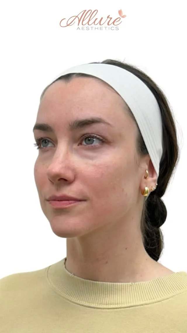 Structural support where it matters most. Subtle correction where it shows first.✨

This treatment was designed to restore continuity from the midface through the lower face by addressing volume loss, shadowing, and facial proportion in multiple areas. Under-eye filler was placed to soften hollowing and reduce a fatigued appearance. Cheek enhancement was used to reinforce midface support, which also helps improve the transition into the under-eye area. Smile lines were treated to smooth facial folds, while jawline contouring created a cleaner, more balanced lower-face profile.

The result is not one isolated change, it is a more cohesive, rested, and structurally balanced appearance.

Results shown after treatment. Results may vary per individual.

Schedule your consultation with Allure Aesthetics through the link in bio.

#UndereyeFiller #CheekFiller #JawlineContour #SmileLineTreatment #AllureAesthetics