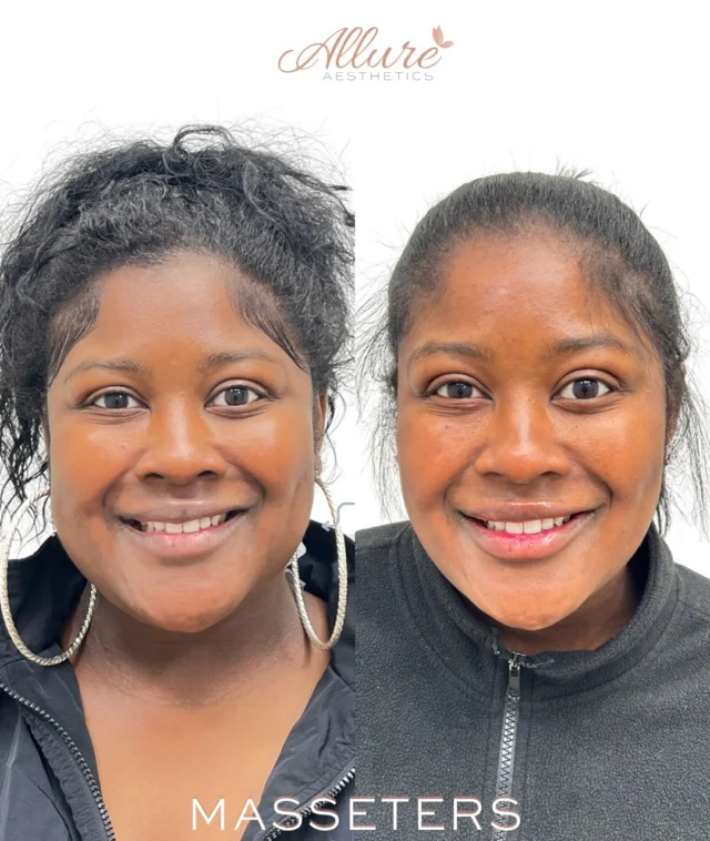 When lower face width is driven by overactive masseter muscles, balance matters.✨

Masseter treatment was performed to soften excessive jaw tension, reduce lower-face heaviness, and create a more proportionate facial shape without altering her natural features. By relaxing the masseter muscle, we’re able to refine the silhouette of the face while also helping patients who experience clenching or grinding.💕

This result shows a slimmer, more structurally balanced lower face with improved facial harmony. Results develop gradually over the following weeks as the muscle relaxes.

Schedule your consultation to see if masseter treatment is the right fit for your anatomy and goals.💓

Results shown after treatment timeframe varies by patient. Results may vary per individual.✨

#AllureAesthetics #MasseterBotox #FacialBalancing #JawlineRefinement #BotoxResults