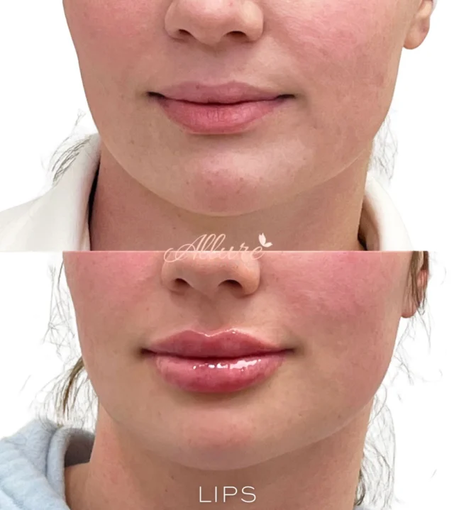 Built over time. Refined with intention. 👄✨

Lip filler was performed strategically over multiple appointments to gradually build shape, improve structural support, and enhance balance between the upper and lower lip. A staged approach allows for controlled refinement while preserving natural movement and proportion.✨

For this client, treatment focused on defining the border, improving symmetry, and creating fuller volume without overwhelming her features. The after photo shown here was taken immediately post-treatment, so mild swelling is expected at this stage.💓

Thoughtful lip enhancement is rarely about doing more at once, it’s about building correctly over time.✨

Schedule your consultation to create a lip plan tailored to your anatomy and goals.💕

After photo taken immediately post-treatment. Swelling may be present. Results may vary per individual.🙌

#AllureAesthetics #LipFiller #LipEnhancement #NaturalLipFiller #FacialBalancing