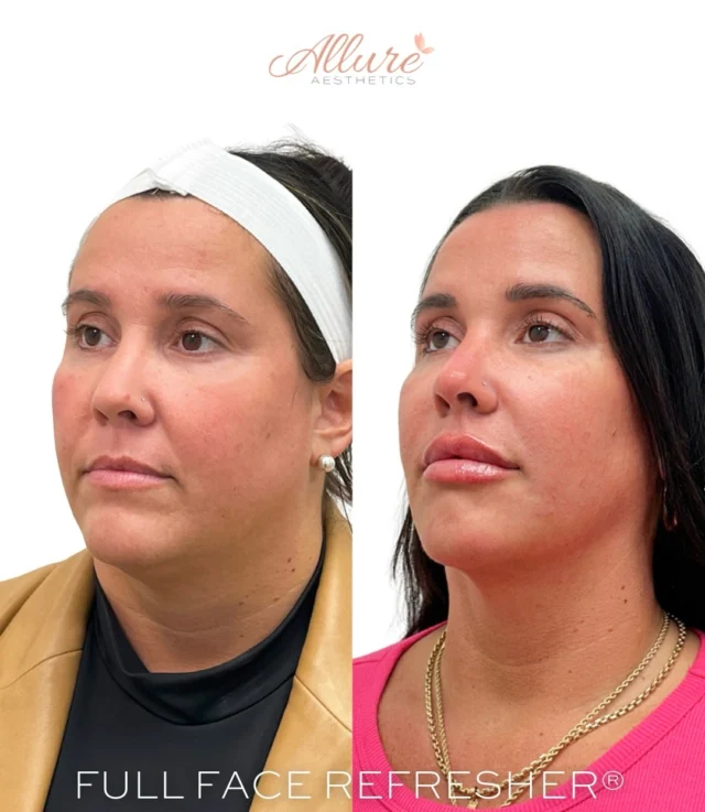 ✨💕 Full Face Refresher® 💕✨

A thoughtfully staged treatment plan can create meaningful change over time. These results compare February 2024 to April 2026, highlighting how strategic enhancements can restore balance, soften areas of facial fatigue, and refine overall proportion while maintaining natural facial identity.

Her customized Full Face Refresher® included treatment to the under eyes, cheeks, smile lines, lips, and chin shadows. Each area was selected with purpose, not to overcorrect, but to improve support, transitions, and harmony throughout the face.

Addressing multiple areas together often creates a more elevated result than treating one feature alone. The goal is a rested, balanced appearance that still looks like you, just more refreshed and structurally supported.

Every treatment plan at Allure Aesthetics is tailored to the individual anatomy, goals, and long term vision of the patient.

Ready for a comprehensive approach to facial rejuvenation? Schedule your consultation through the link in bio. ✨

Results may vary per individual.