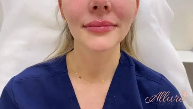 Fresh Off the Syringe 💉 

Immediate post-treatment lip enhancement designed to refine shape, restore hydration, and create balanced volume with precision. Freshly treated lips will appear fuller at first, with swelling expected immediately after injections before settling. 💋 

At Allure Aesthetics, every lip treatment is customized to your anatomy and goals, whether you prefer subtle structure, soft hydration, or a more defined finish. 👄 

Ready for lips that are thoughtfully enhanced, never overdone? Schedule your consultation today.✨

Results may vary per individual💉

#LipFiller #LipEnhancement #AllureAesthetics #NaturalLipFiller #AestheticInjector