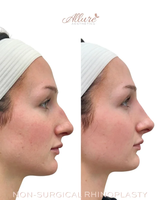 Non-Surgical Rhinoplasty 👃

Strategic refinement can dramatically improve facial balance without surgery, incisions, or extended downtime. In this treatment, filler was precisely placed to camouflage the dorsal hump, create a smoother nasal profile, and improve overall proportion from bridge to tip.

By adding structure in the correct areas, we’re often able to redirect attention away from irregularities and create a more harmonious side profile while preserving natural 

These results are shown immediately after treatment. Final settling occurs over the following weeks
If you’ve been bothered by bumps, asymmetry, or profile imbalance but are not ready for surgery, a customized consultation can determine whether non-surgical rhinoplasty is the right option for you.

Schedule your consultation through the link in bio.

Results may vary per individual.