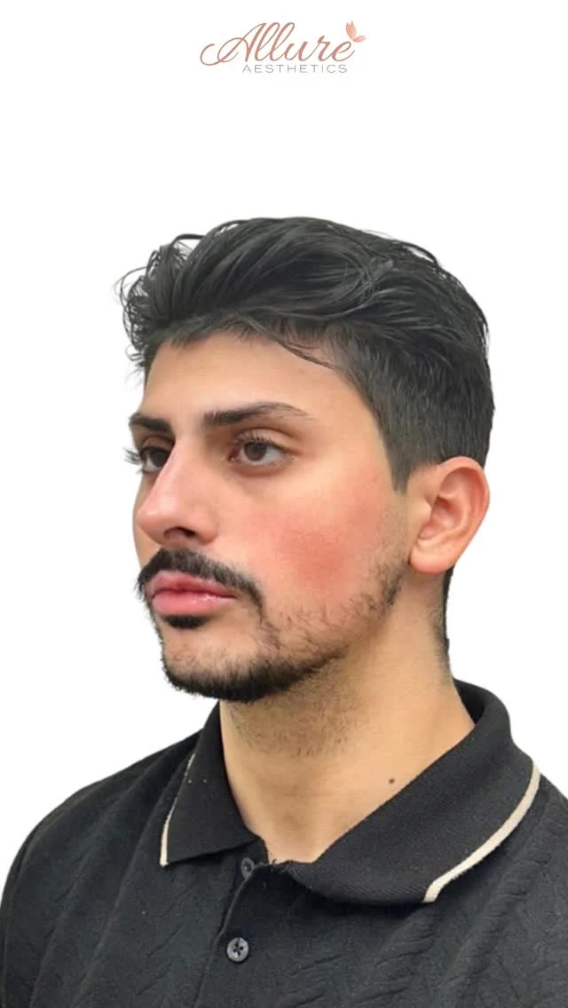 Strategic profile refinement, completed in a single session.

This treatment plan focused on correcting facial proportions by addressing three key areas, the nose, lips, and chin, to create a more structured and cohesive profile.

A non-surgical rhinoplasty was performed to refine the nasal bridge and improve contour without surgery. Lip filler was used conservatively to support shape and proportion, rather than over-volumizing. Chin enhancement was then performed to strengthen projection and create better alignment with the lower face.

Treating these areas together allows us to balance the profile as a whole, rather than overcorrecting a single feature. The goal is not to change the face, but to improve structural harmony and proportion from every angle.

Results shown are immediately after treatment, swelling may be present. Results may vary per individual.

To learn more about customized treatment planning, schedule your consultation through the link in bio.

#facialbalancing #nonsurgicalrhinoplasty #chinfiller #lipfiller #profilebalance