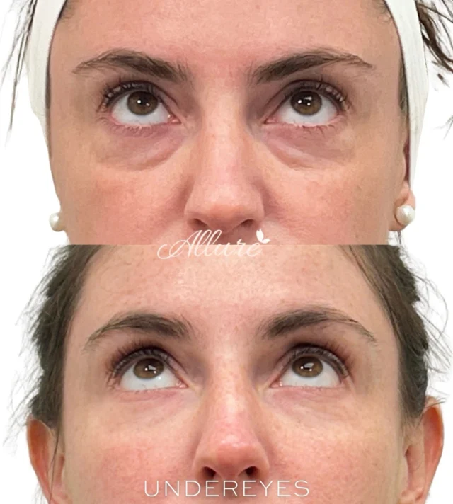 Under eye 👀 hollowing is not just a volume concern, it can create shadowing, facial fatigue, and a harsher transition between the lower eyelid and cheek. Treatment was performed to improve structural support beneath the eyes, soften the tear trough area, and create a smoother, more balanced under eye contour while maintaining natural facial proportion.✨

In these before and afters, you can see a noticeable reduction in shadowing and improved continuity through the midface without overcorrection. The goal is always precise placement and subtle enhancement that complements the patient’s anatomy.💓

Results may vary per individual.

To schedule a consultation for under eye rejuvenation, contact Allure Aesthetics￼ 🫶🏼✨

#UnderEyeFiller #TearTroughTreatment #FacialBalancing #AllureAesthetics #UnderEyeRejuvenation