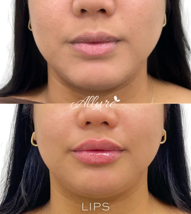 Defined, hydrated lips with improved structural balance and contour, immediately after treatment. 💋

This treatment was performed to enhance lip shape, improve border definition, and create better proportion between the upper and lower lip, while maintaining softness and natural facial harmony. Immediate post treatment swelling may be present.

Results shown immediately after treatment. Results may vary per individual.

To schedule your consultation, visit the link in bio. #LipFiller #LipEnhancement #FacialBalance #LipContour #AllureAesthetics