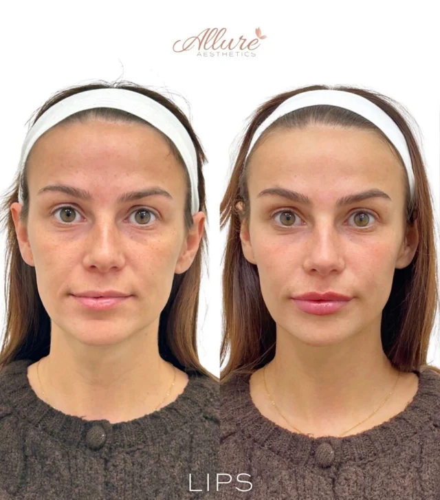 Strategic lip enhancement is never just about adding volume, it’s about improving facial proportion, supporting lip structure, and creating balance between the upper and lower lip while maintaining a natural result.

For this patient, 1 syringe was used during a single session to refine lip shape, enhance border definition, and improve overall symmetry without overfilling the lips. The result is a softer, more balanced appearance that still fits her facial anatomy naturally.

These results are immediately after treatment, swelling may be present. Results may vary per individual.

To schedule your lip filler consultation, visit the link in bio or contact Allure Aesthetics directly.

#LipFiller #LipEnhancement #FacialBalance #DermalFiller #AllureAesthetics