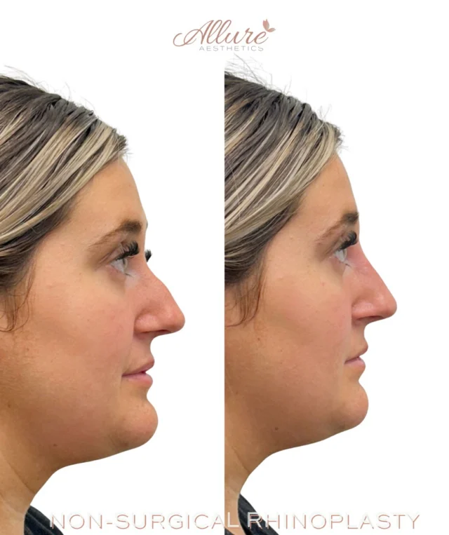 NON-SURGICAL RHINOPLASTY 👃 

Refining nasal structure without surgery can dramatically improve overall facial proportion and side profile balance. In this case, strategic filler placement was performed in a single session to create a smoother nasal contour, improve profile harmony, and support a more balanced transition between the forehead, nose, and chin.

The goal was not to change her features, but to create structural refinement while maintaining natural facial integrity and movement.

These results were achieved in one session. Results may vary per individual.

To learn more about non-surgical rhinoplasty or schedule a consultation, contact Allure Aesthetics.

#NonSurgicalRhinoplasty #FacialBalancing #ProfileBalancing #DermalFiller #AllureAesthetics