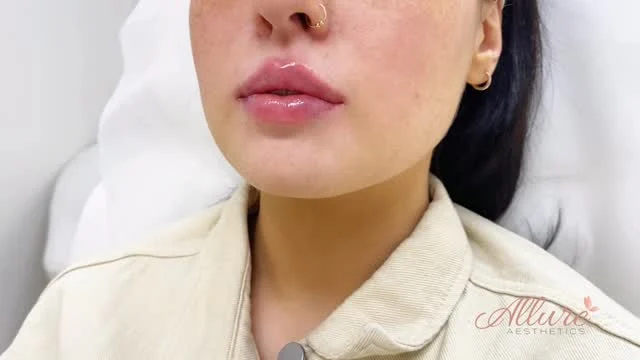 Fresh off the syringe 👄✨

Defined, hydrated, balanced lips with shape that complements her natural features beautifully. A customized approach is what creates soft, flattering results that never look overdone. The structure, symmetry, and overall finish already look stunning, and these will continue to settle beautifully over the next couple of weeks. 💉

Results shown immediately after treatment. Swelling and bruising may be present. Results may vary per individual.

#LipFiller #LipEnhancement #NaturalLips #LipGoals #DermalFiller"l
