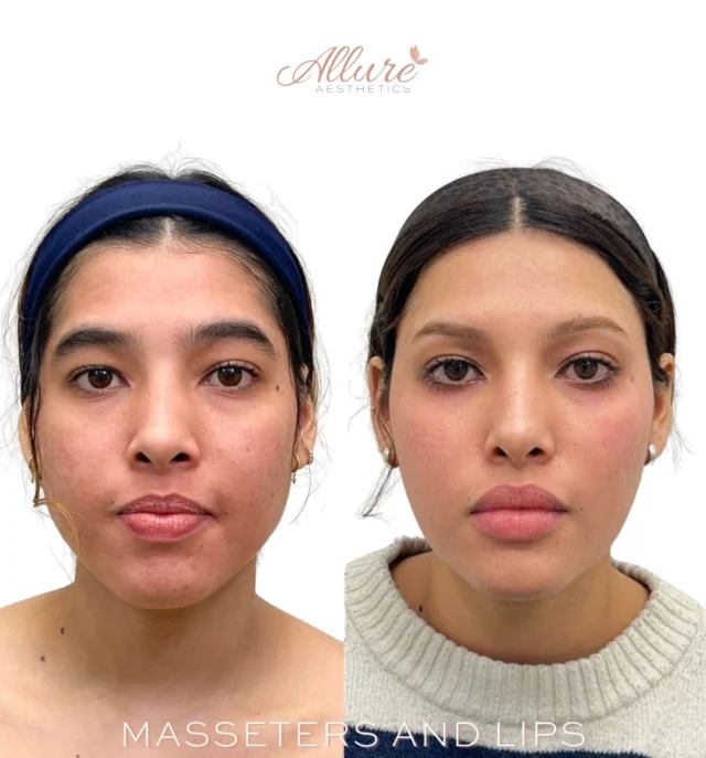 This treatment plan combined lip filler, masseter Dysport®, and tip of nose Dysport® to create better facial proportion and overall harmony from profile to frontal view. Lip filler was strategically placed to improve shape and support while maintaining softness and movement. Masseter treatment was performed to soften lower face width and create a more refined facial contour. Dysport® to the tip of the nose helped reduce downward pull for improved balance at rest and with expression.✨

A customized approach will always create more cohesive results than treating one area alone.💓

To schedule your consultation with one of our providers, contact Allure Aesthetics or visit the link in bio.✨💗

Results may vary per individual.

#LipFiller #Dysport #FacialBalancing #MasseterBotox #AllureAesthetics