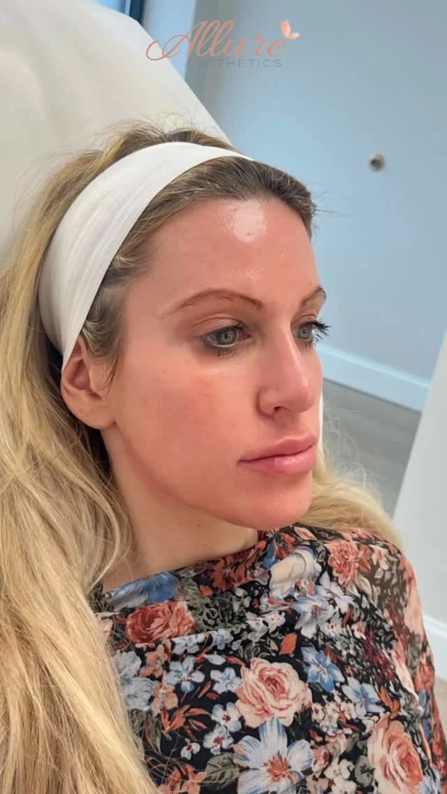 Full Face Refresher®

Strategic facial balancing is about more than treating a single area, it’s about restoring support, proportion, and harmony throughout the entire face.

Her treatment plan included: Dissolving and refilling the lips for a more refined shape. Filler to the under eyes, cheeks, chin shadows, smile lines, temples, nose, and jawline.

Upper face Dysport® for the forehead, 11 lines, crow’s feet, brows, and jelly rolls• Dysport® placed to the chin, DAO’s, masseters, lip flip, and nasal tip lift.

MOXI®, ZO® Skin Health, and Hydroquinone to support overall skin quality, tone, and texture.

Every area was treated intentionally to create softer, more balanced facial structure while maintaining natural movement and proportion.

Results may vary per individual.