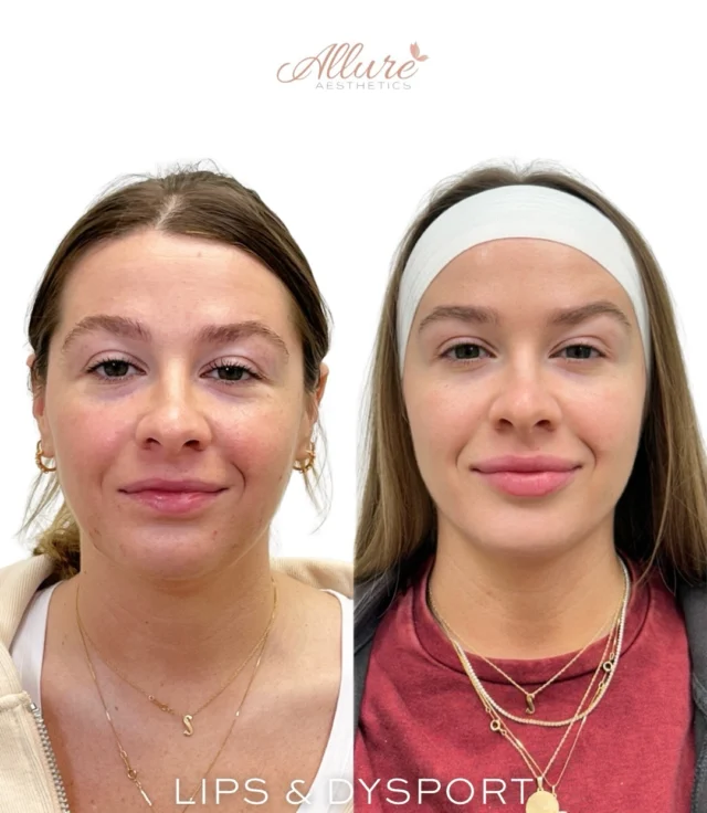 Subtle lip enhancement paired with Dysport to support smoother dynamic movement and improved facial balance, while maintaining natural expression and proportion. ✨

The goal was not to change her features, but to create a more harmonized appearance through soft structural support and prevention-focused treatment planning. Swipe through to see relaxed expression, frown movement, and forehead movement after treatment.💗

Treatment performed by one of our experienced providers at Allure Aesthetics.💕

Results may vary per individual.

#Dysport #LipFiller #PreventativeAging #FacialBalance #MedicalAesthetics
