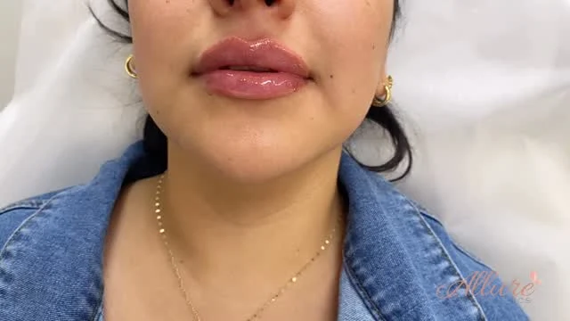 Fresh off the syringe.

Strategic lip enhancement designed to improve balance, hydration, and structural support while maintaining soft movement and natural proportion. Immediate post treatment swelling may be present, final results continue to settle over the following days.

At Allure, every lip treatment is customized to the patient’s anatomy, facial harmony, and long term aesthetic goals, never a one size fits all approach.

Results may vary per individual.

#LipFiller #LipEnhancement #FacialBalance #MedicalAesthetics #AllureAesthetics