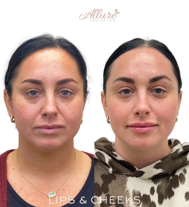 Lips and cheeks were treated together to improve overall facial proportion and create better structural balance throughout the mid and lower face.

Cheek support was strategically placed first to help support facial architecture and soften transitions between the cheeks, nasolabial area, and lips. Treating both areas together often creates a more harmonized result compared to treating the lips alone.

The lips were then refined to improve balance, shape, and projection relative to the patient’s natural anatomy.

Treatment performed by our provider at Allure Aesthetics.

Results may vary per individual.

#LipFiller #CheekFiller #FacialBalancing #FullFaceRefresher #AllureAesthetics