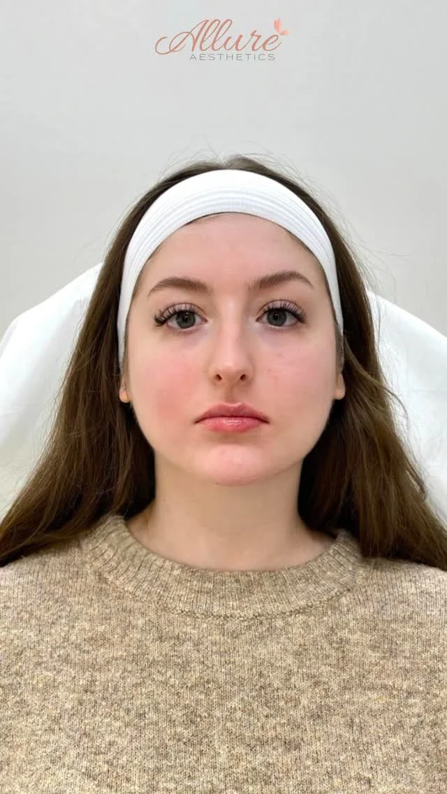 Lips, cheeks, and chin were strategically treated in just one session to help improve facial proportion, support structural balance, and create a more harmonized appearance.

Subtle enhancement can make a significant difference when treatment planning is approached intentionally and tailored to the individual’s anatomy.

Treatment areas:
• Lips for refined shape and support
• Cheeks to restore facial structure and contour
• Chin to improve profile balance and lower face harmony

Results shown after one session. Results may vary per individual.

If you’re ready to discuss your treatment goals, book your desired treatment and our providers will assess your facial anatomy in person to create the most appropriate treatment plan for you.

#LipFiller #FacialBalancing #CheekFiller #ChinFiller #AllureAesthetics