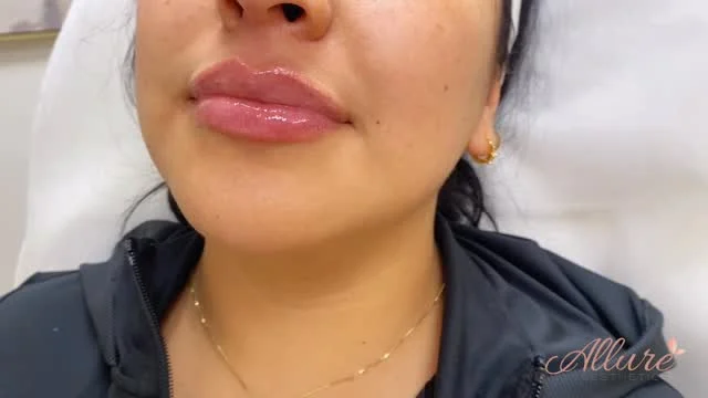 Freshly injected, beautifully defined.

Strategic lip filler placement was used to enhance the cupid’s bow, improve border definition, and create a softer, more balanced shape while maintaining natural movement and proportion.

Subtle structure can make a significant difference when the lips are approached with precision and facial harmony in mind.

Results shown immediately post treatment, swelling is expected and final results will continue to settle over the next 2 weeks. Results may vary per individual.

#LipFiller #LipEnhancement #CupidBowFiller #FacialBalance #AllureAesthetics